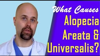 What Causes Alopecia Areata and Universalis [upl. by Ellemac124]