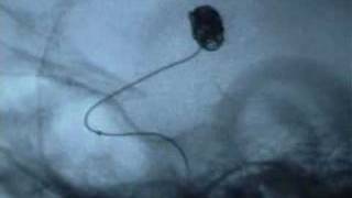 Coil embolization of aneurysm [upl. by Emmalee]