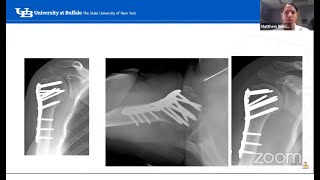 Proximal humerus fractures [upl. by Betty]