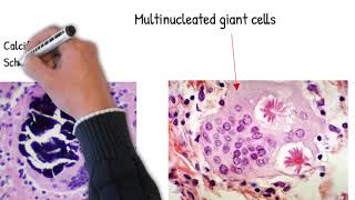 Sarcoidosis easy explained causes mechanism and pathology [upl. by Esille]