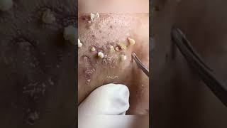 Points Noirs Incroyablesblackheads pimple acne [upl. by Longawa]