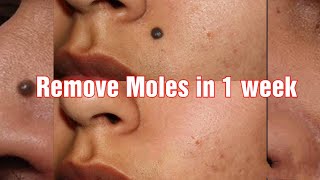 How to Remove Mole on Facetil on face naturally at HomeDIY miracle mole removal remedy [upl. by Assetak968]