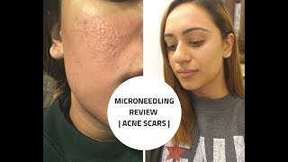 MICRONEEDLING REVIEW  Acne Scars  Before and After  PART 1 [upl. by Anelhtac]