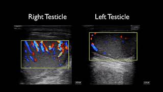 Global Ultrasound Institute Orchitis and Epididymitis on Point of Care Ultrasound [upl. by Crispen]