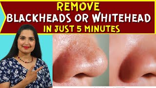 How To REMOVE Blackheads Whiteheads AT HOME EASY Face Mask  Clears Skin DIY BLACKHEAD REMOVER [upl. by Jamey]