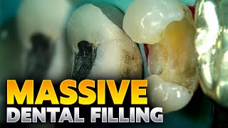 40 Live Restoration of Fractured Dental Filling [upl. by Marfe]