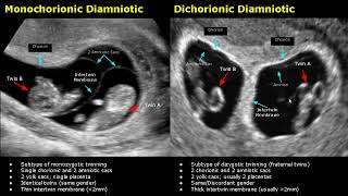 Fetal Twins Ultrasound Normal Vs Abnormal  MonochorionicDichorionicDiamnioticMonoamniotic USG [upl. by Terbecki]