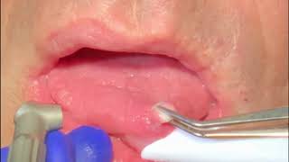 Solea Fibroma removal  Dr Heath Brantley Narrated [upl. by Etnohc]