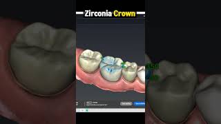 Zirconia Crown Procedure Explained  Pros and Cons in 1 minute [upl. by Nawk]