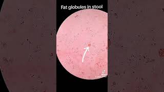 Fat globules in stool [upl. by Heidy]