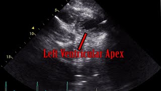 Parasternal Short Axis View Lower Apex Level  Loop [upl. by Yeslah]