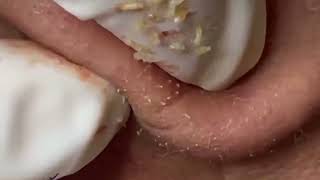 Ultimate Guide to Removing Blackheads and Whiteheads 👃🐽🤢 removeblackhead [upl. by Clayberg79]