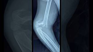 SUPRACONDYLAR FRACTURE HUMERUS youtubeshorts shorts viral [upl. by Remlap963]