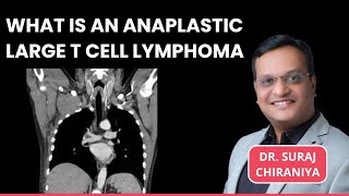 What is Anaplastic Large T Cell Lymphoma  Sign amp Symptoms Treatment Options by Dr Suraj Chiraniya [upl. by Aisekal]