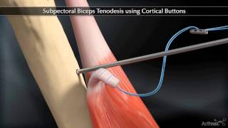 Subpectoral Biceps Tenodesis Using Cortical Buttons [upl. by Tarah]