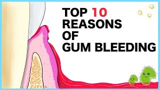 Gum Bleeding Top 10 causes [upl. by Bunder]