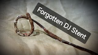 Forgotten DJ Stent  Cystoscopic Removal  Dr Tayyab Riaz Ch [upl. by Neetsirhc375]