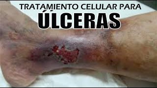 ÚLCERAS VARICOSAS ARTERIALES Y DIABÉTICAS 🦵TRATAMIENTO CELULAR 👣 Magneto LÁSER 🦵 Dr IVÁN GUTIÉRREZ [upl. by Emoraj]