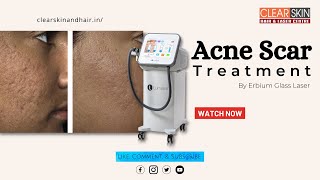 permanent removal of Acne Scar  Acne Scar Treatment by Fr Erbium Glass Laser  DrNKailash [upl. by Ecirad]