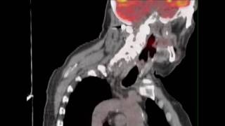 PETCT Scan Diagnostic Radiology Mercy Medical Center Canton Ohio cantonmercyorg [upl. by Shulock730]