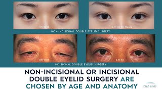 How NonIncisional or Incisional Asian Double Eyelid Surgery are Chosen by Age and Anatomy [upl. by Eanram]