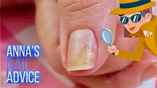 Nail Separation  Causes  Early Treatment of Onycholysis Annas Nail Advice [upl. by Stanwinn476]