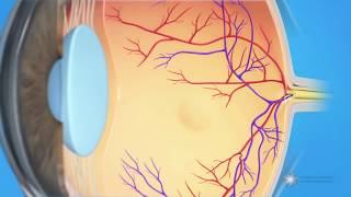 What is cystoid macular edema [upl. by Duff]