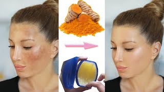 Get Rid of Dark Spots with Vaseline amp Turmeric  Bright Skin in 3 Days [upl. by Leanard679]