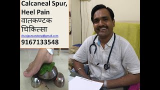 Calcaneal spur treatment  Planter fasciitis  पाष्णीशुल  वातकण्टक  अग्निकर्म  Heel pain [upl. by Aisya]