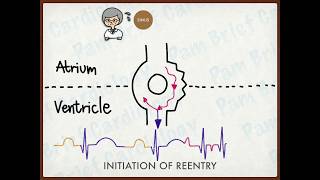 Reentry tachycardia mechanism [upl. by Legnaros603]