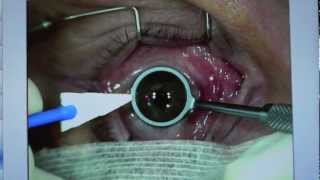 LASEK procedure [upl. by Enomas]