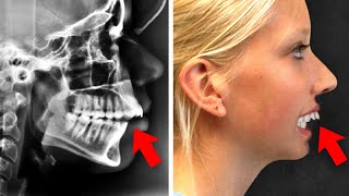 How to CORRECT Excessive OverbiteOrthodontic Options [upl. by Tempa]