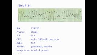 ECG Exercise 34 [upl. by Frangos]