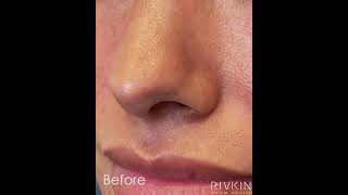 Nostril Correction nonsurgicalrhinoplasty nostril shortsviral [upl. by Larianna]