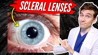 Scleral Lenses for Keratoconus 7 Facts You Need to Know [upl. by Ekul]