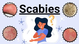 Scabies Signs Symptoms Causes Prevention and Treatment Novice Medic [upl. by Alwin]