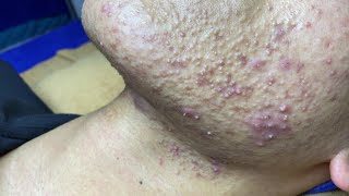 Best Pimple Popping P1  Mụn Dậy Thì Siêu Hấp Dẫn P1  SacDepSpa181 [upl. by Rosenzweig]