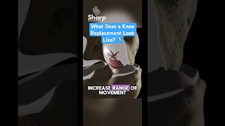 What Does a Knee Replacement Look Like 🦵kneereplacement physiotherapy [upl. by Reube57]