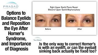 Cause of Horners Syndrome Must be Determined before Corrective Eye and Eyelid Surgery [upl. by Elttil]