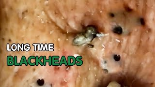 Blackheads Removal Acne Hidden For a Long Time [upl. by Suirtemid84]