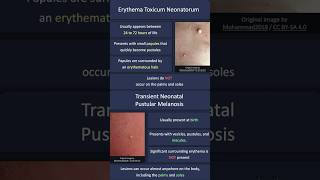 Erythema Toxicum Neonatorum vs Transient Neonatal Pustular Melanosis [upl. by Aseena]