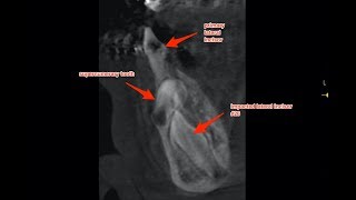 Extraction of Supernumarary Tooth and Exposure of Impacted Lower Lateral Incisor For Orthodontic Eru [upl. by Tallia]