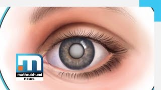 Cataract Symptoms And Treatments Doctor 2PMMathrubhumi News [upl. by Annodahs]