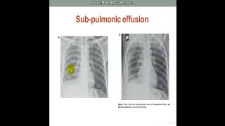 PleuralEffusionDiagnosticApproach [upl. by Bazluke404]