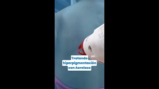 Trata la hiperpigmentación con Aerolase [upl. by Ahslek]