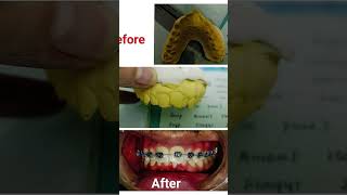 Orthodontics treatment 45 month progress ortholearning orthodontics [upl. by Rednasela]