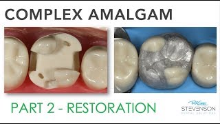 Complex Amalgam Restoration  Part 2 [upl. by Garrick]