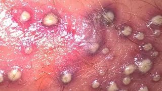 Worst Pimples I Have EVER Seen Pimple Popping amp Zit Removal [upl. by Ahsinet]