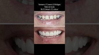 Veneers  Crowns Natural style BL3  OM3  bleach 3  colour dentist smile australia fyp [upl. by Yentroc]