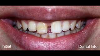 Diastema Closure Step By Step [upl. by Attenehs]